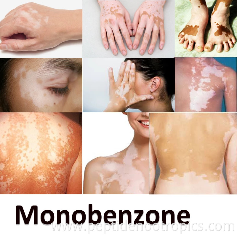 monobenzone powder effects